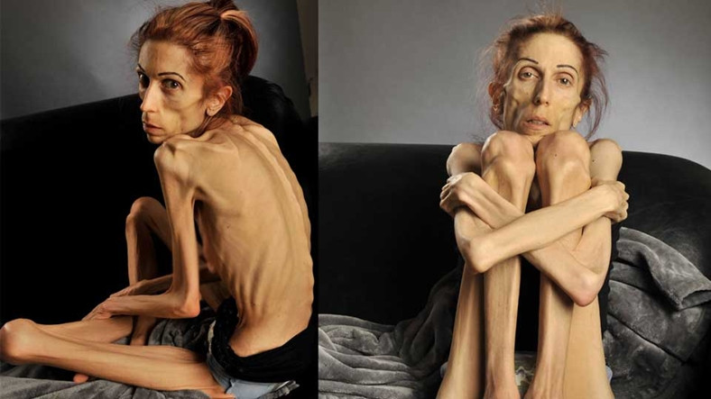 İnsanları 'Manken Gibi Olmalıyım' Yanılgısıyla Bir Deri Bir Kemik Bırakan Hastalık: Anoreksiya