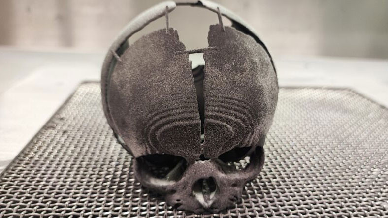 Kafatası Olmadan Doğan Bebek, 3D Yazıcıda Üretilen Yapay Kafatası ile Hayatta Kaldı