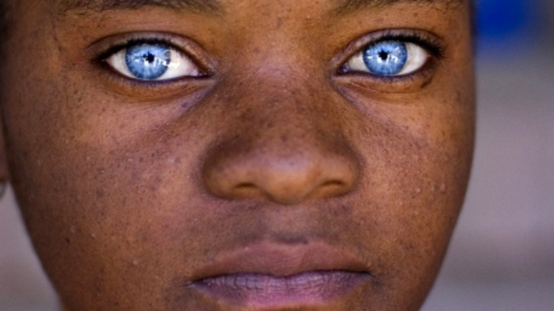 Siyahi İnsanlarda Mavi Göz Görülmesinin Öğrenince Bilime Hayran Bırakan İlginç Nedeni