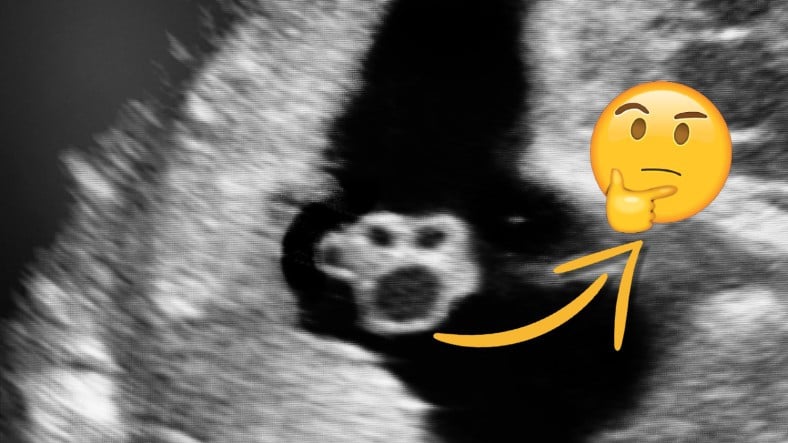 Bi' Kedi Gördüm Sanki: Hamile Kadınların Ultrason Görüntüsündeki Bu 'Pati' İzi Aslında Ne?