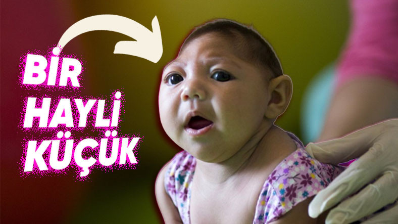 Kimi Yeni Doğan Bebeklerde Sıra Dışı Bir Baş Görünümüne Sebebiyet Veren Rahatsızlık: Mikrosefali